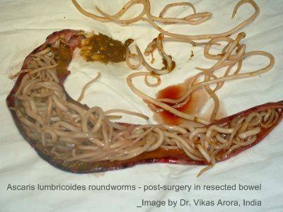 400x300xascariasis-roundworms.jpg.pagespeed.ic.aJY2Rgetmd