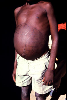 A child affected with schistosomiasis